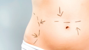 tummy tuck Camarillo ca