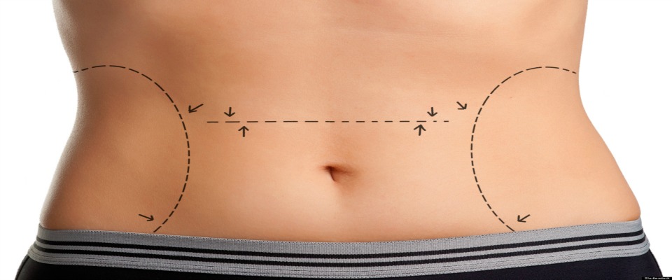 Liposuction Surgery